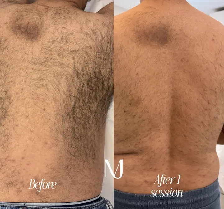 1 session - laser hair removal