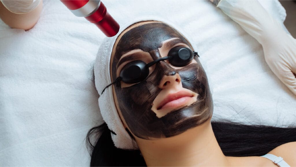 carbon laser peel