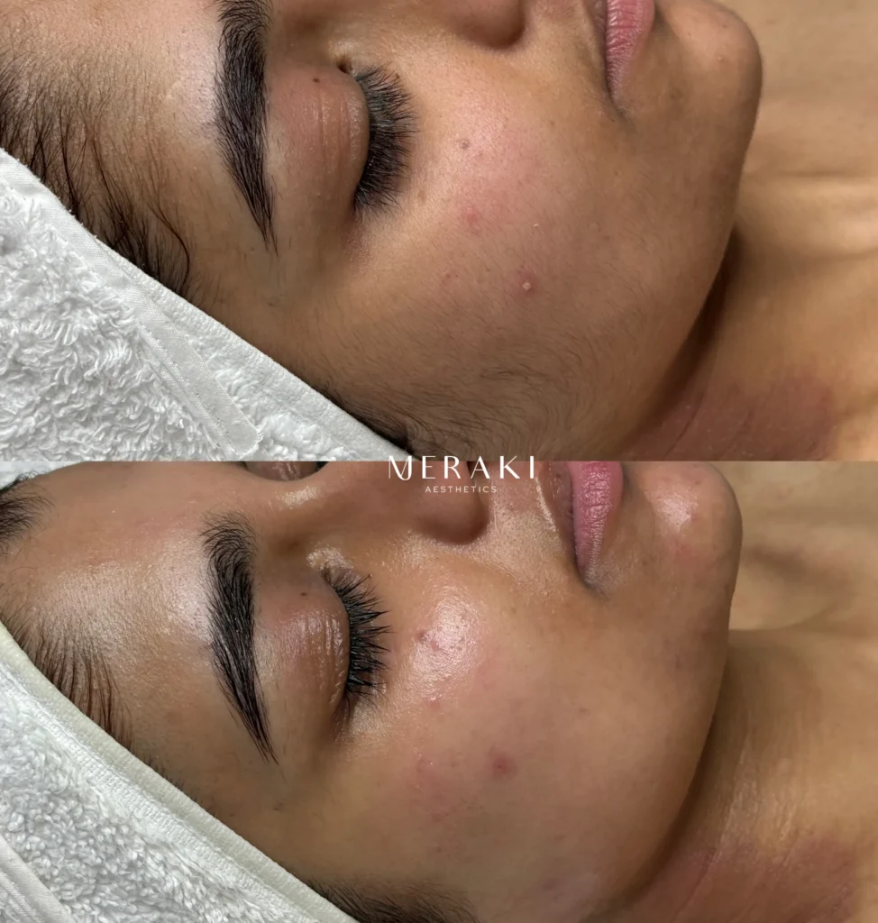 facial