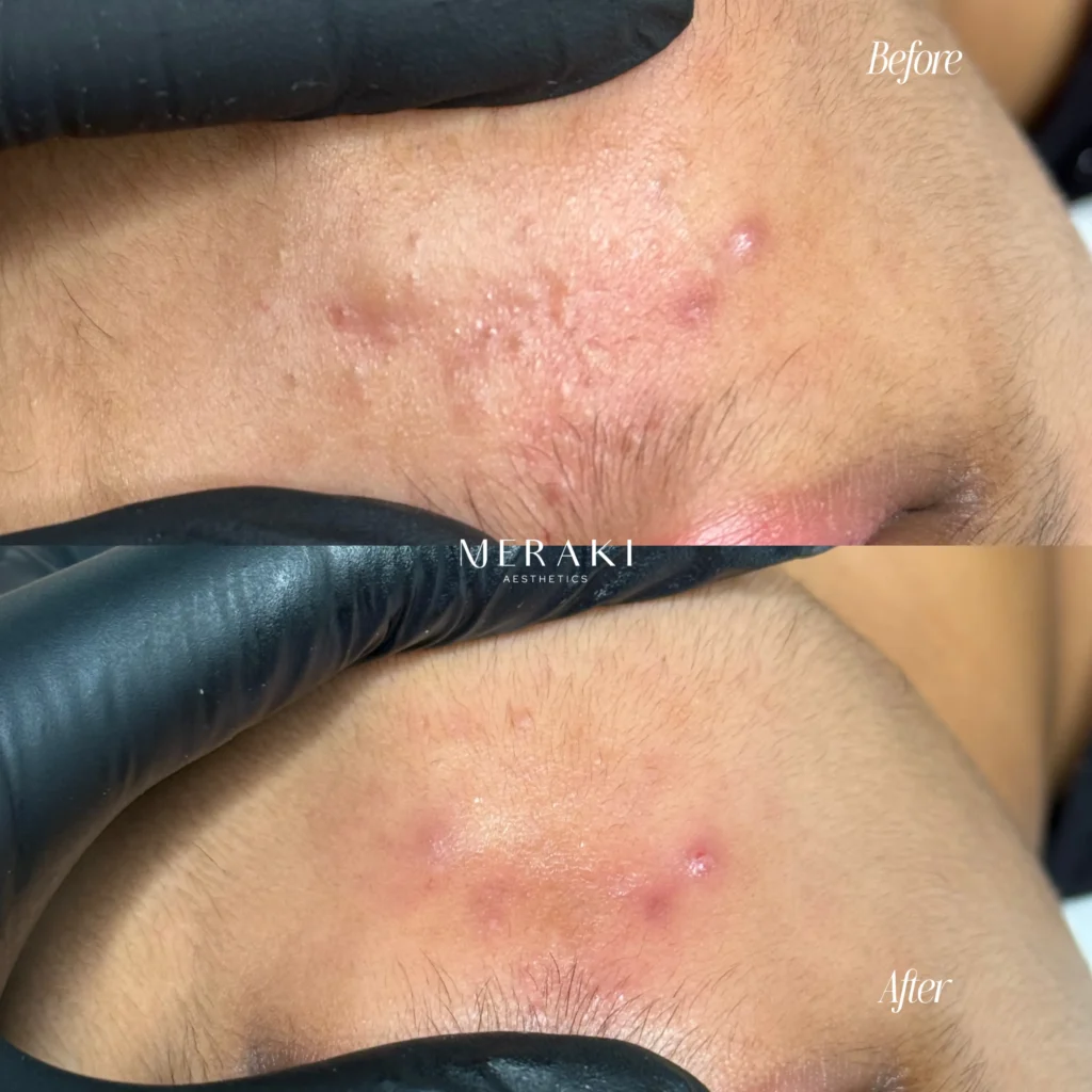 Targeted Acne Clarifying Treatment