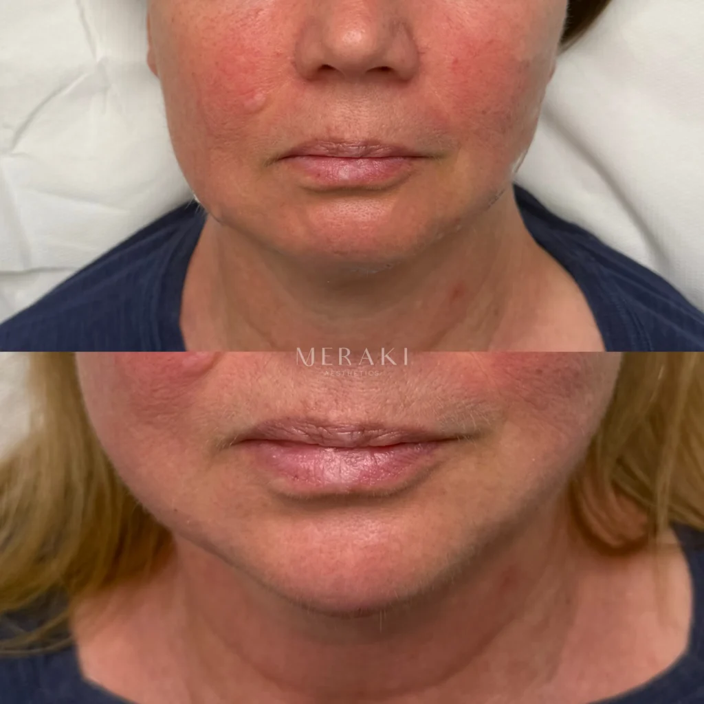 Lip & Perioral Area Restoration